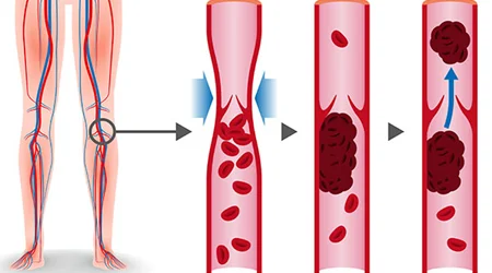 علل ایجاد لخته خون در بدن (ترومبوز)