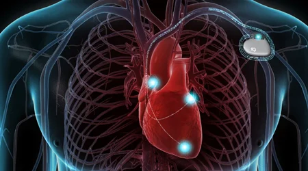 باتری قلب برای بیماران با HCM