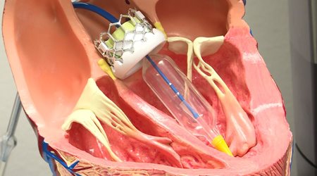 والووپلاستی دریچه ها 🔗