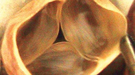 دریچه پولمونر - ریوی 🔗