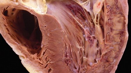 دریچه میترال 🔗