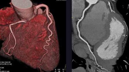 سی تی آنژیوگرافی 🔗