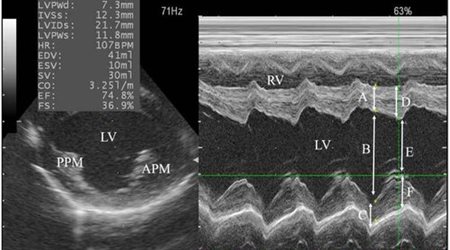 اکوکاردیوگرافی 🔗
