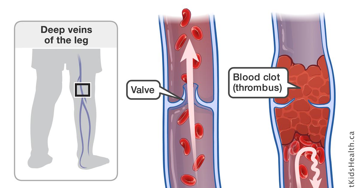 علل و ریسک فاکتورهای ایجاد DVT