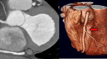 سی تی آنژیو چیست؟