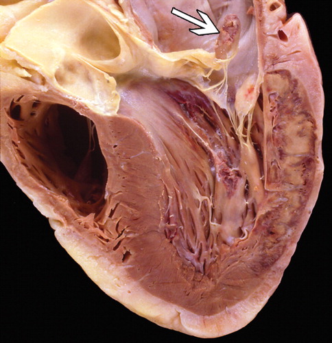 دریچه میترال 🔗