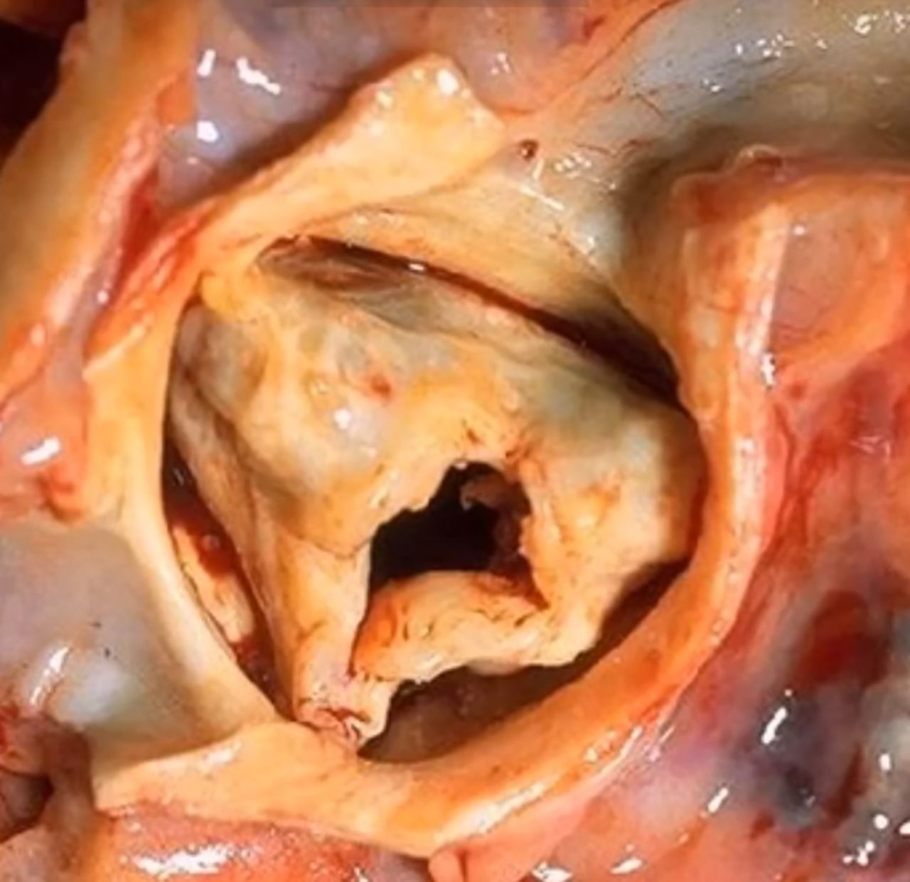 تنگی دریچه آئورت