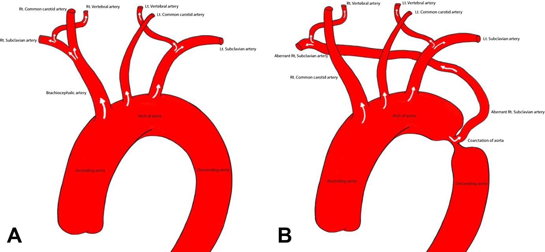کوارکتاسیون آئورت