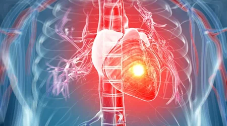 حمله حاد قلبی و علل آن
