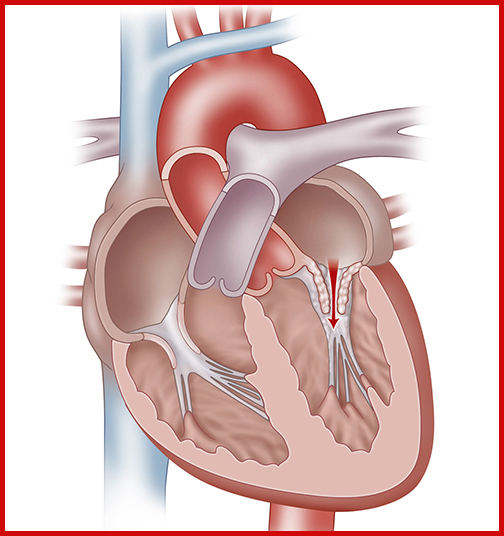 تنگی میترال