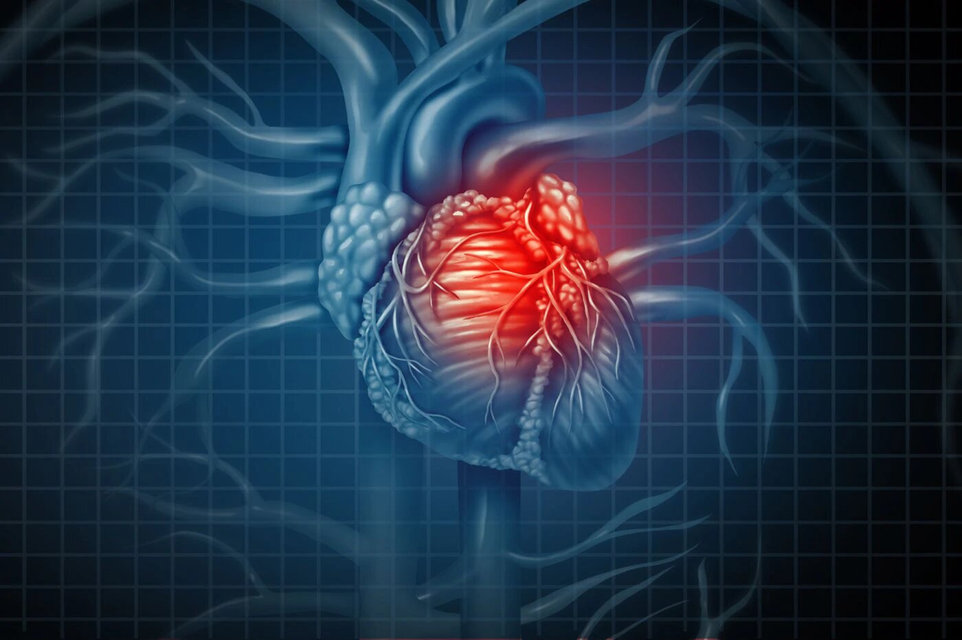 سکته حاد قلبی چیست؟