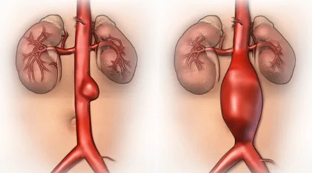 آنوریسم آئورت شکمی